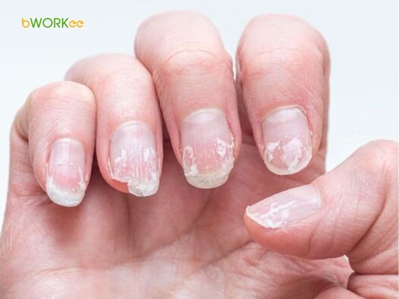 Chăm sóc móng không đúng cách